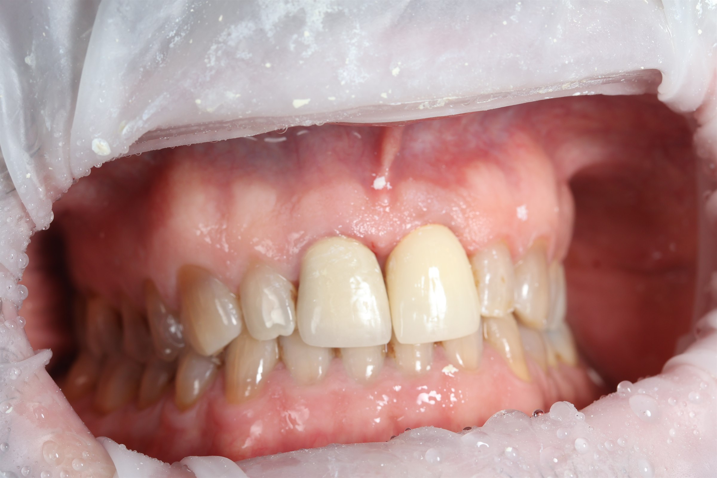After anterior dental implant treatment, case three