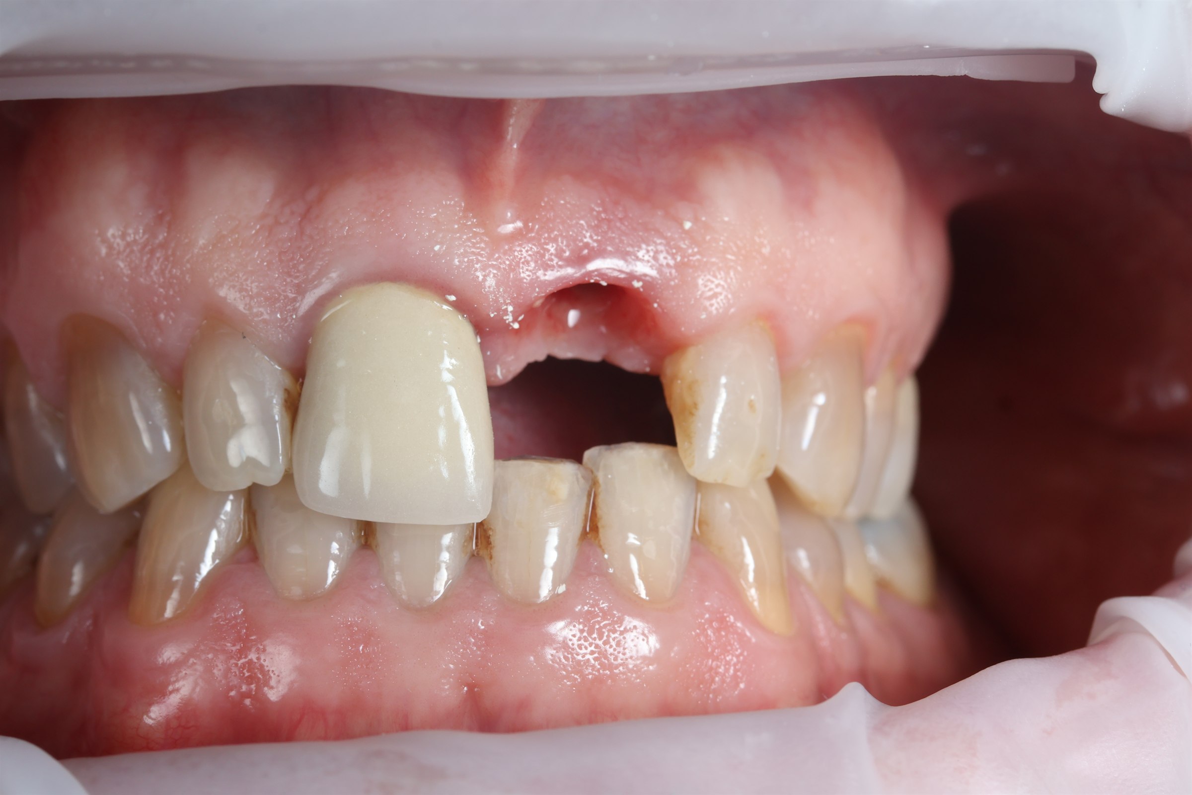 Before anterior dental implant treatment, case three