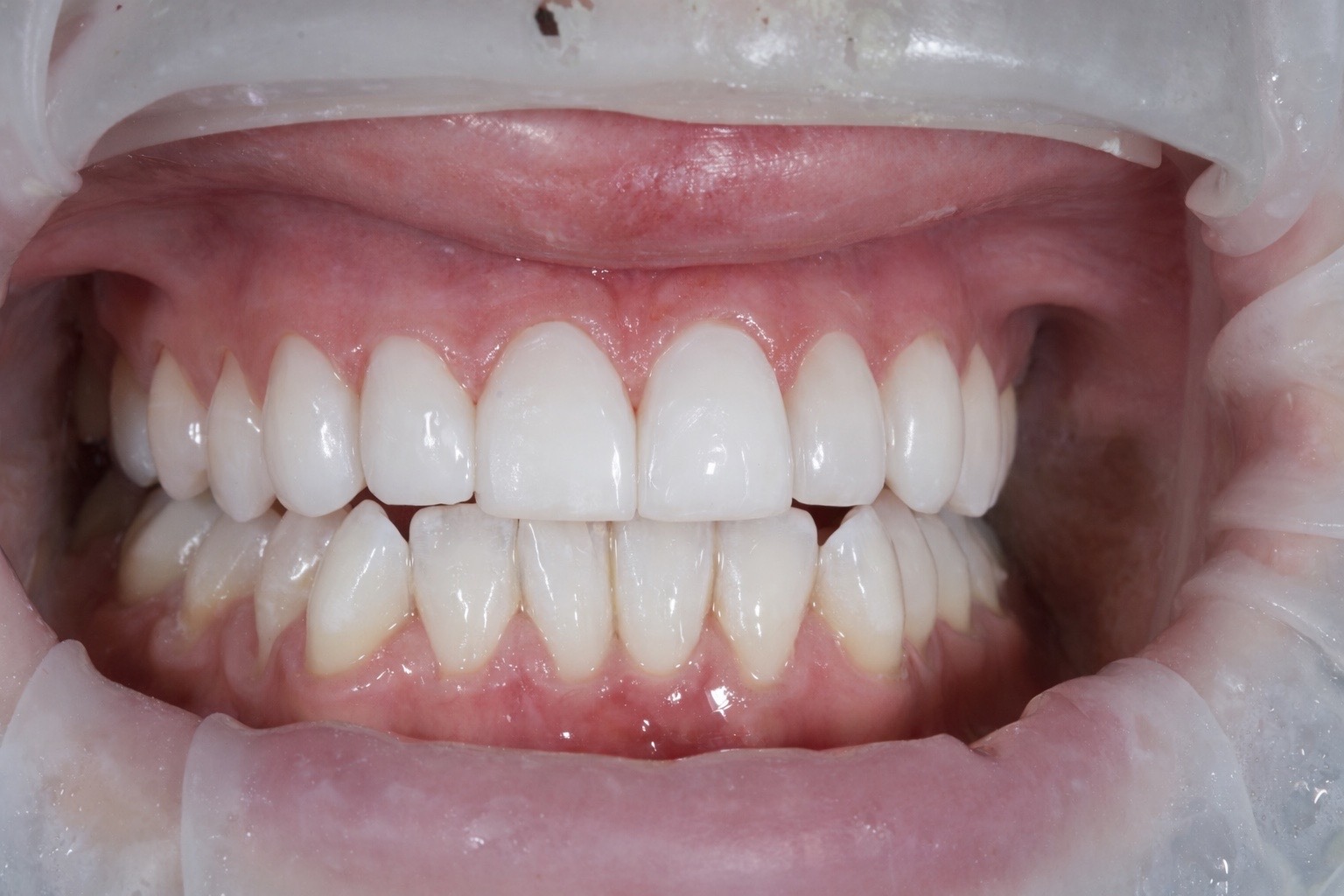 After composite bonding treatment, case one