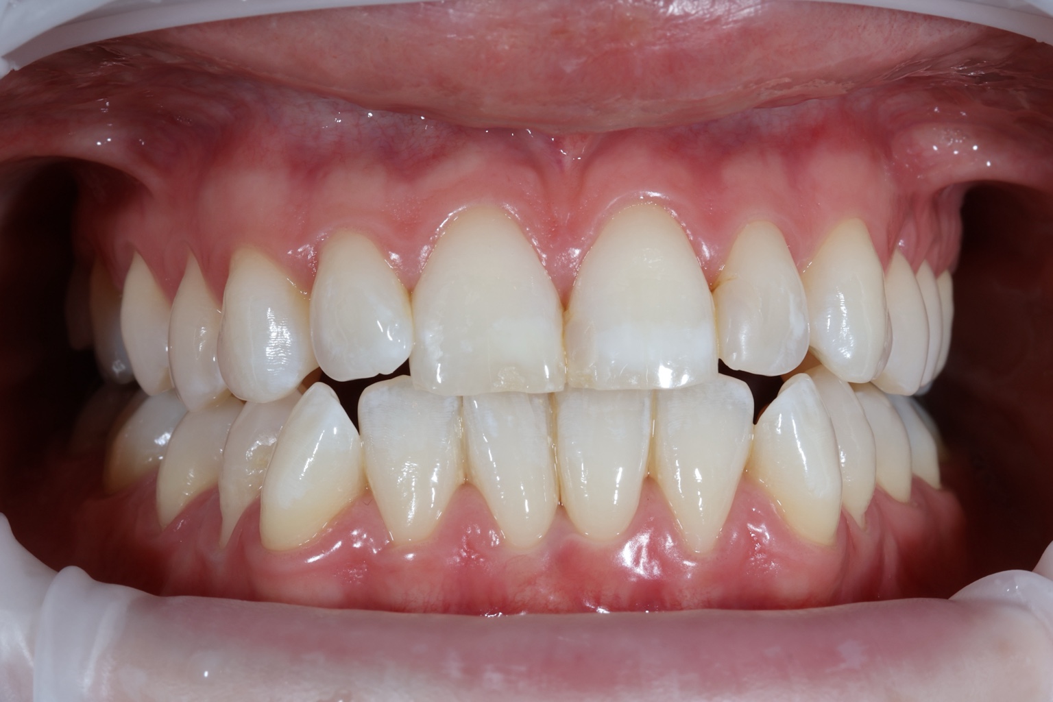 Before composite bonding treatment, case one