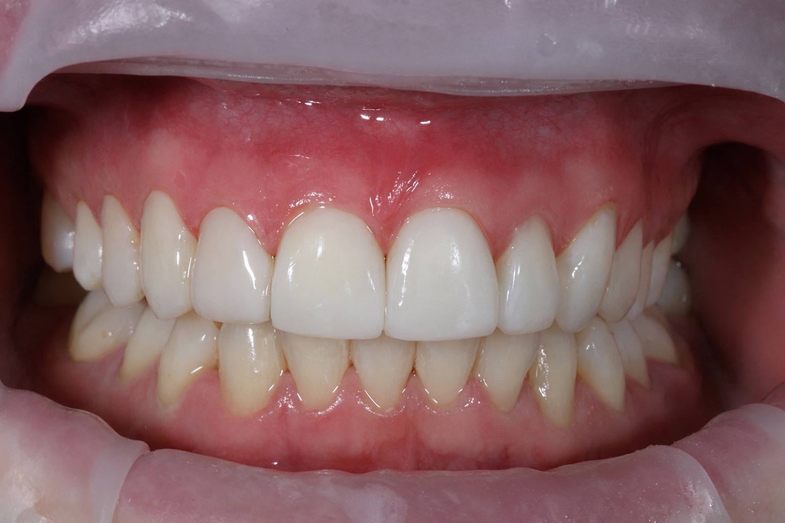 After composite bonding treatment, case two