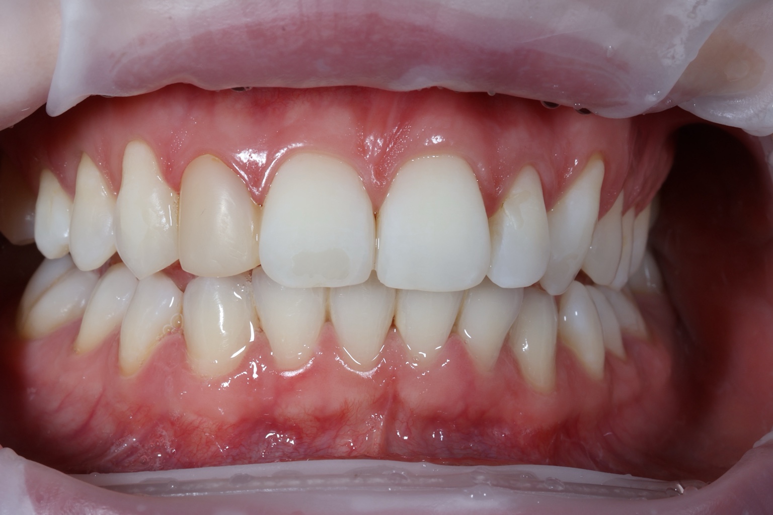 Before composite bonding treatment, case two