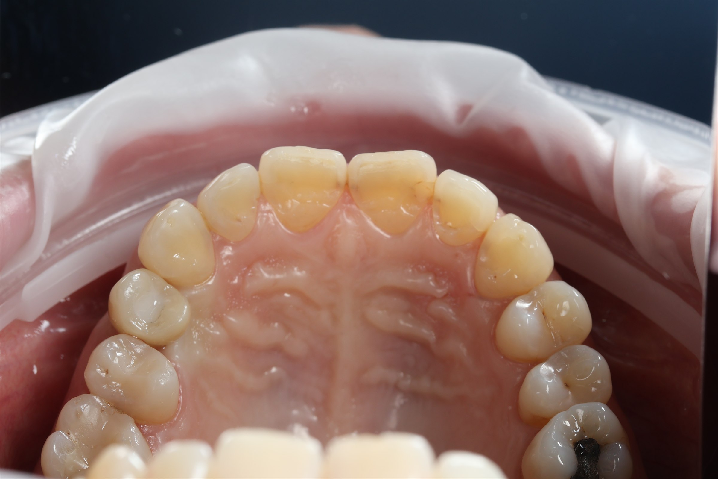 After posterior dental implant restoration, case four
