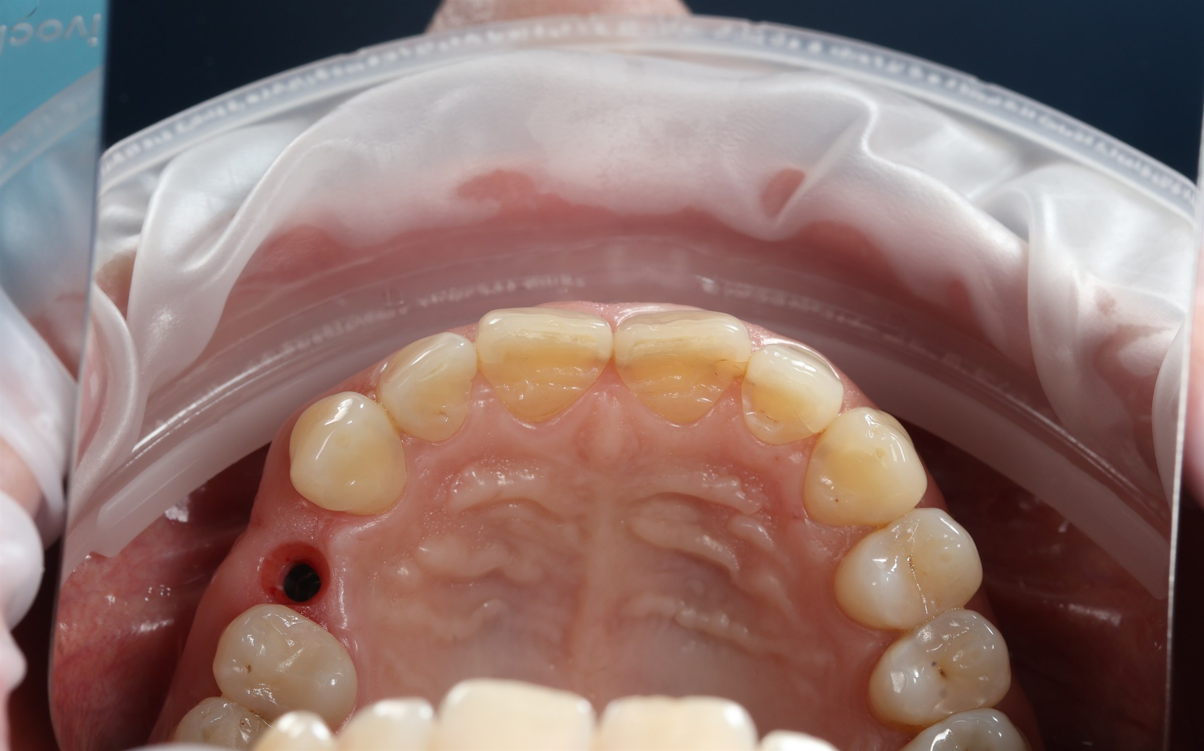Before posterior dental implant restoration, case four